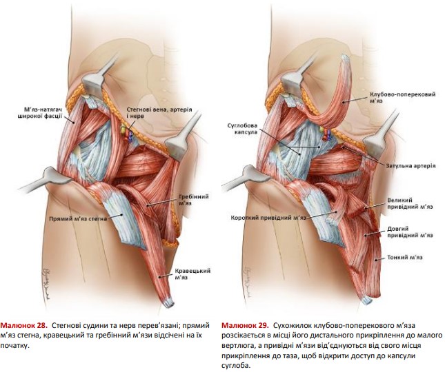 Сухожилок клубово-поперекового м’яза розсікають
