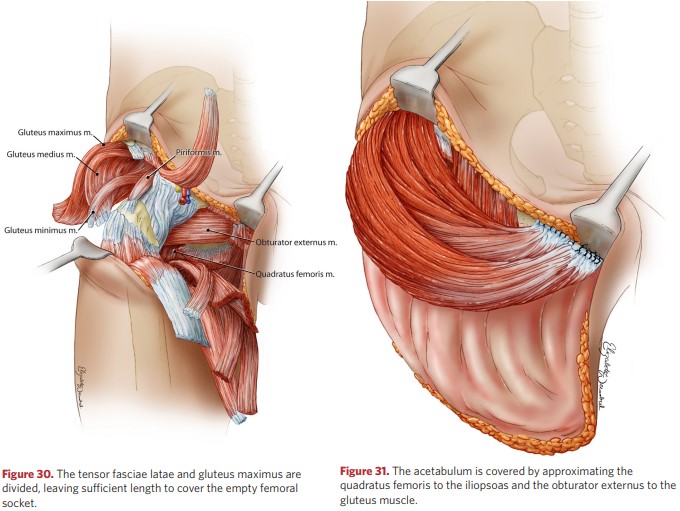 The acetabulum is closed