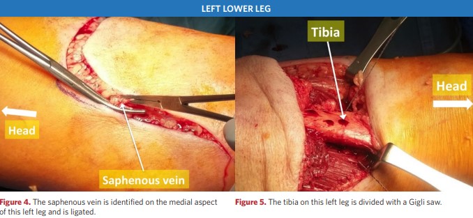 The tibia on the left leg is split by a Jigli saw