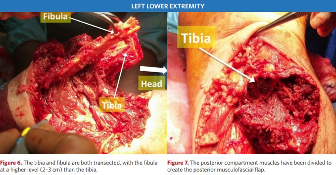 Tibia and fibula severed