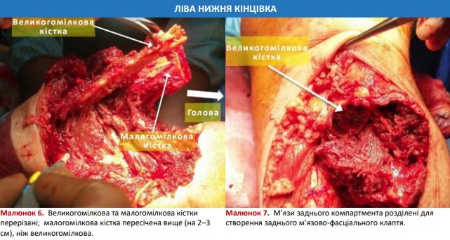 Великогомілкова та малогомілкова кістки перерізані