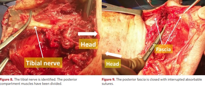 The posterior fascia is closed with knotted absorbable sutures