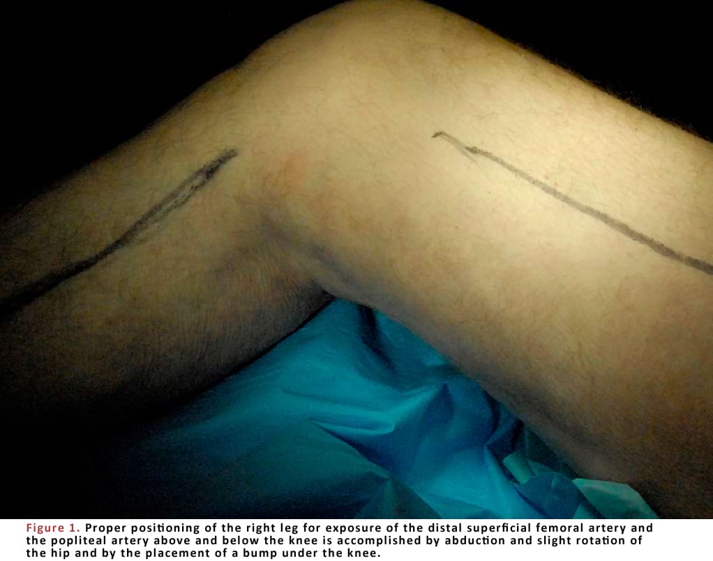 Proper positioning of the right leg for exposure of the distal.