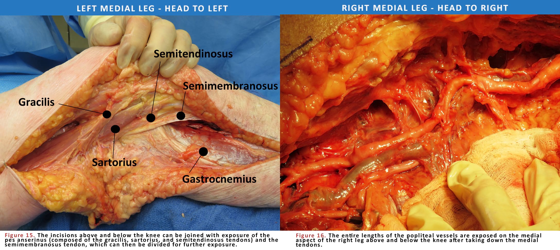 Left Medial Leg - Head To Left and Right Medial Leg - Head To Right