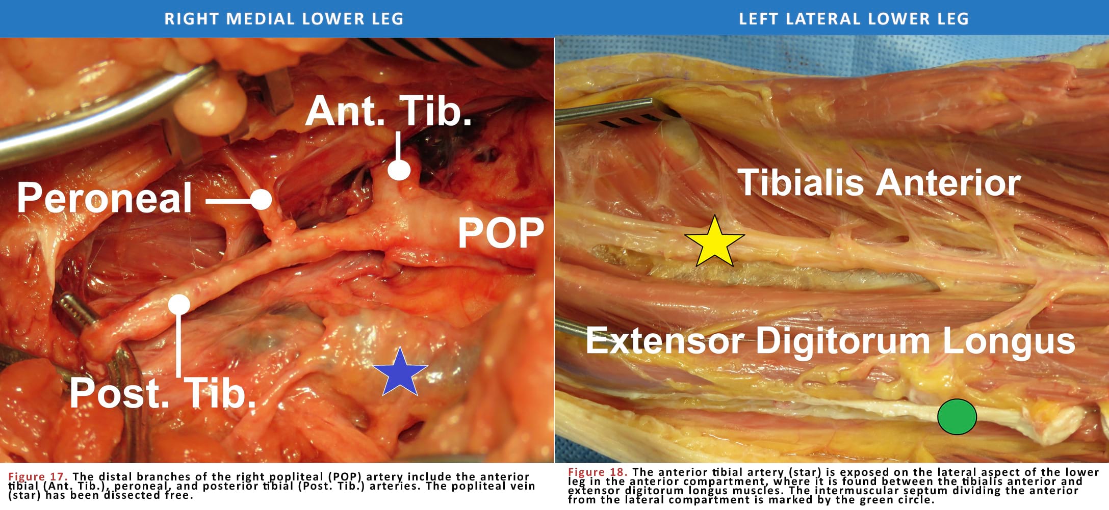 Right Medial Lower Leg and Left Lateral Lower Leg