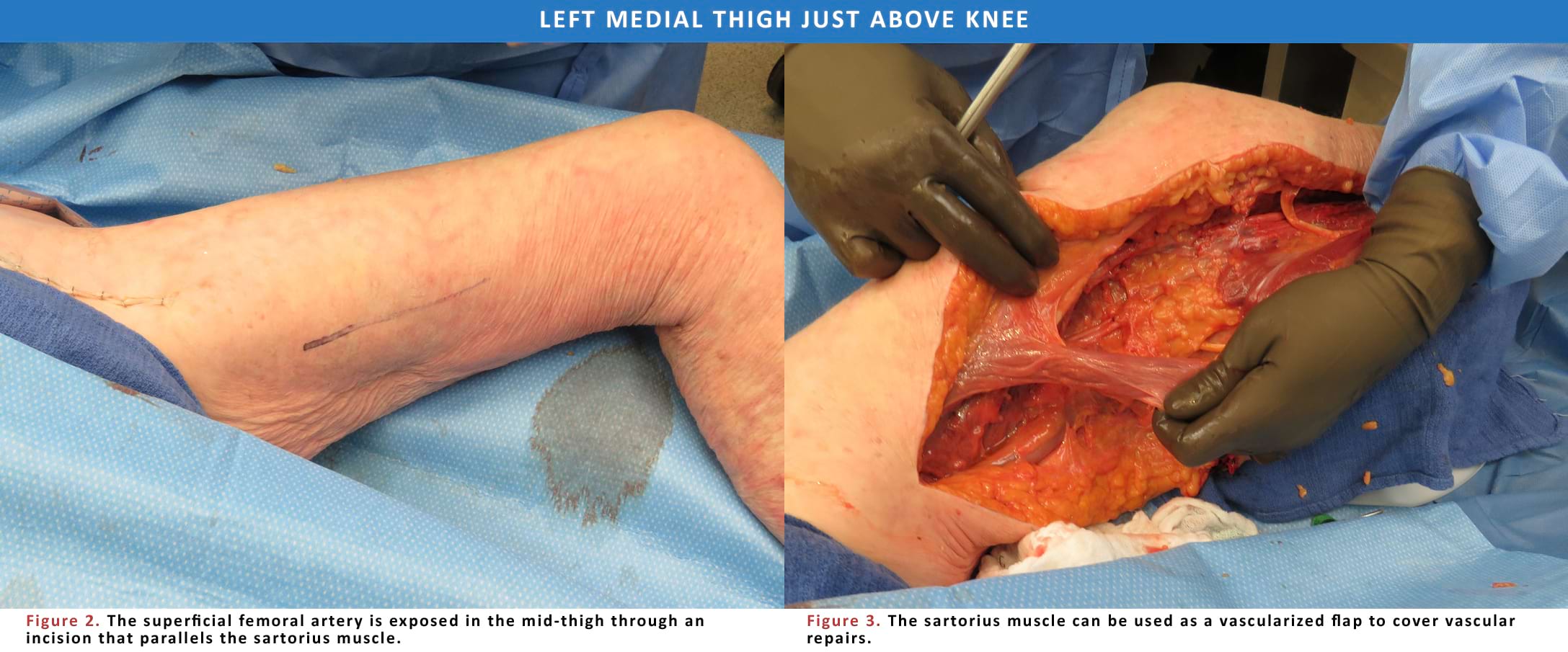 Left Medial Thigh Just Above Knee.