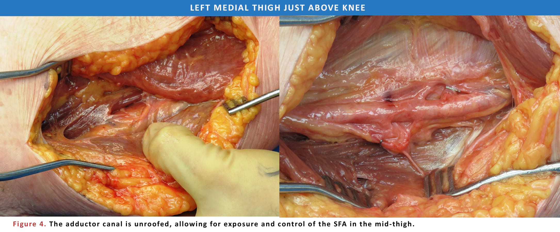 The adductor canal is unroofed.