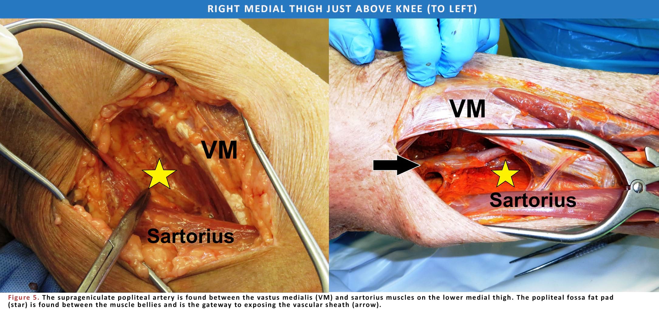 The suprageniculate popliteal artery is found between the vastus medialis (VM) and sartorius muscles on the lower medial thigh.