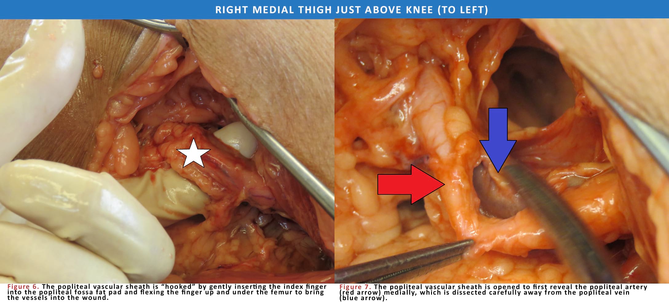 Right Medial Thigh Just Above Knee (To Left)