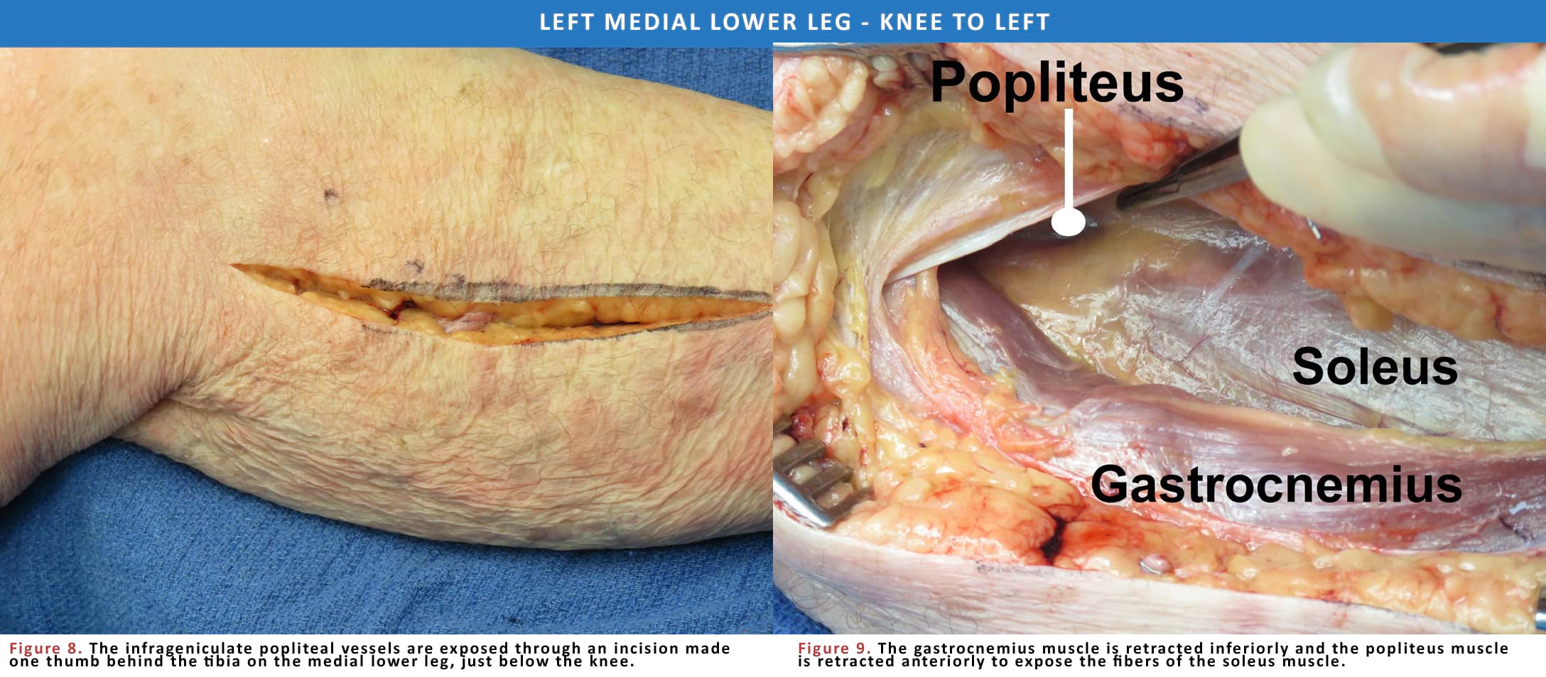 The infrageniculate popliteal vessels are exposed through an incision made one thumb behind the tibia on the medial lower leg, just below the knee.