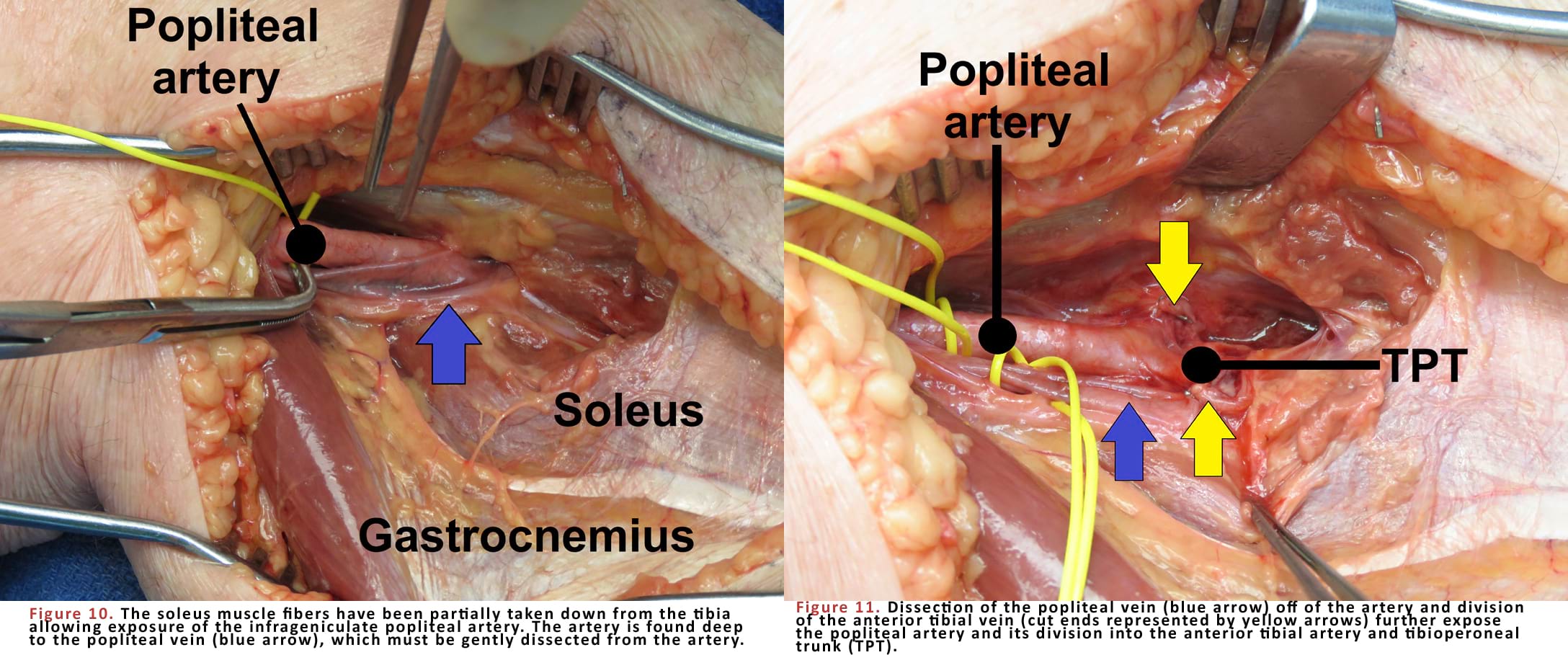 Dissection of the popliteal vein off of the artery and division of the anterior tibial vein