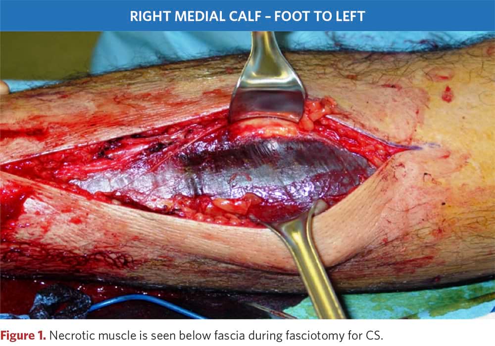 Fasciotomy of the medial surface of the right calf