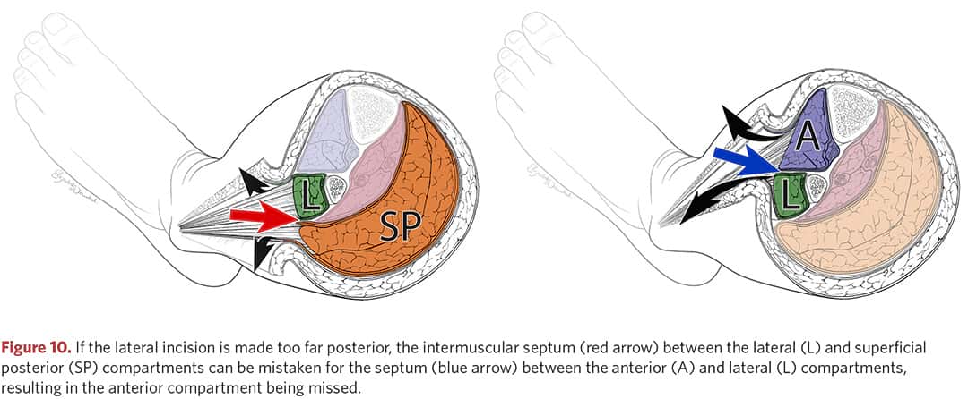 Anatomy of the intermuscular septum of the lateral surface of the left tibia