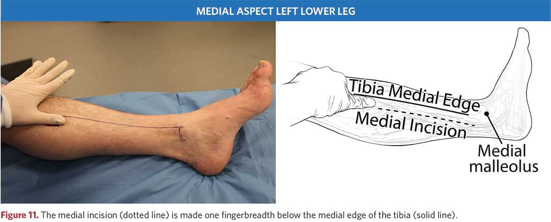 Medial incision of the left and right tibia