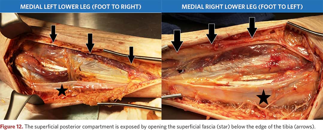 Exposure of the superficial posterior compartment of the left tibia