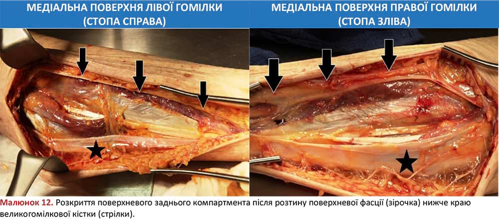 Розкриття поверхневого заднього компартмента лівої гомілки