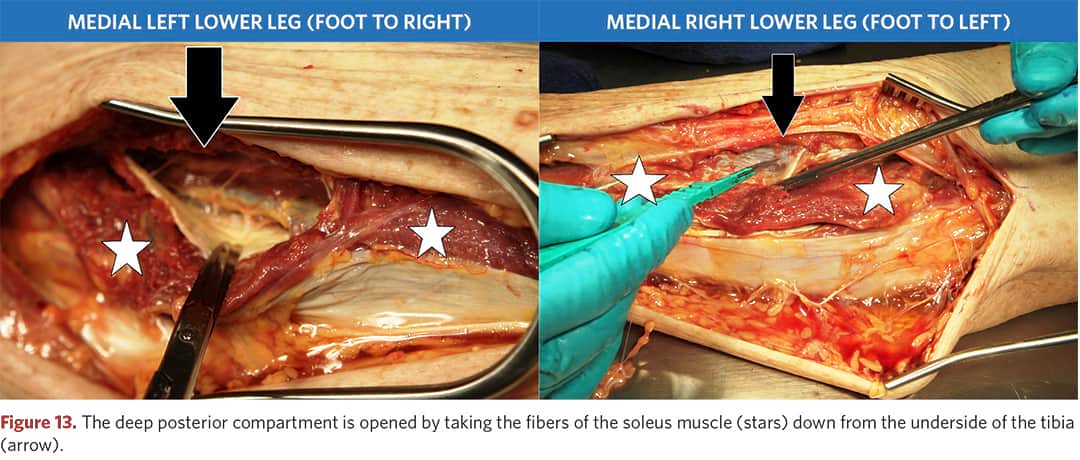 Exposure of the deep posterior compartment of the left and right tibia