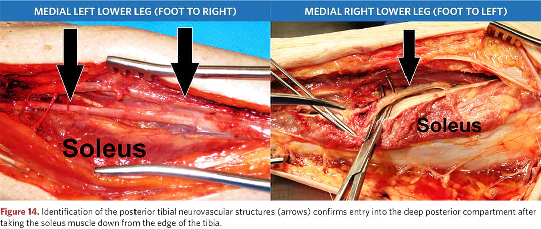 Identification of neurovascular structures behind the tibia