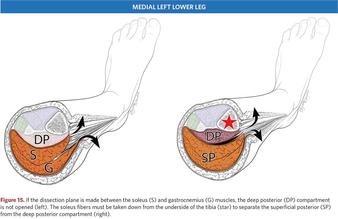 Compartment Syndrome of the Thigh