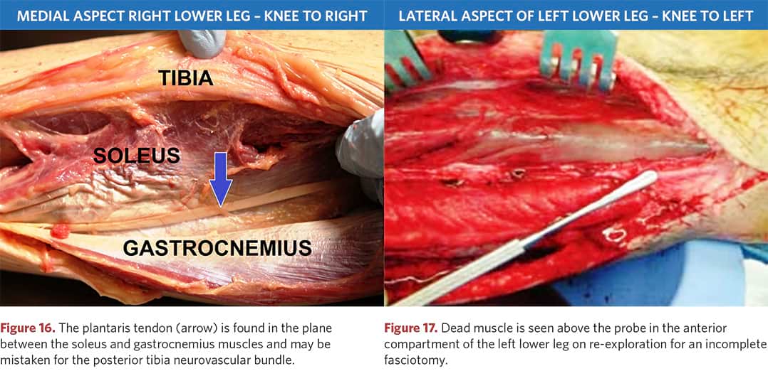 Tendons of the foot