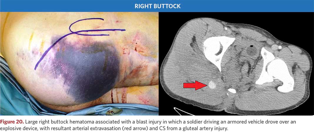 Extensive hematoma of the right buttock