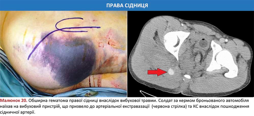 Обширна гематома правої сідниці