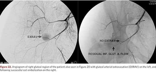 Angiogram of the right gluteal area