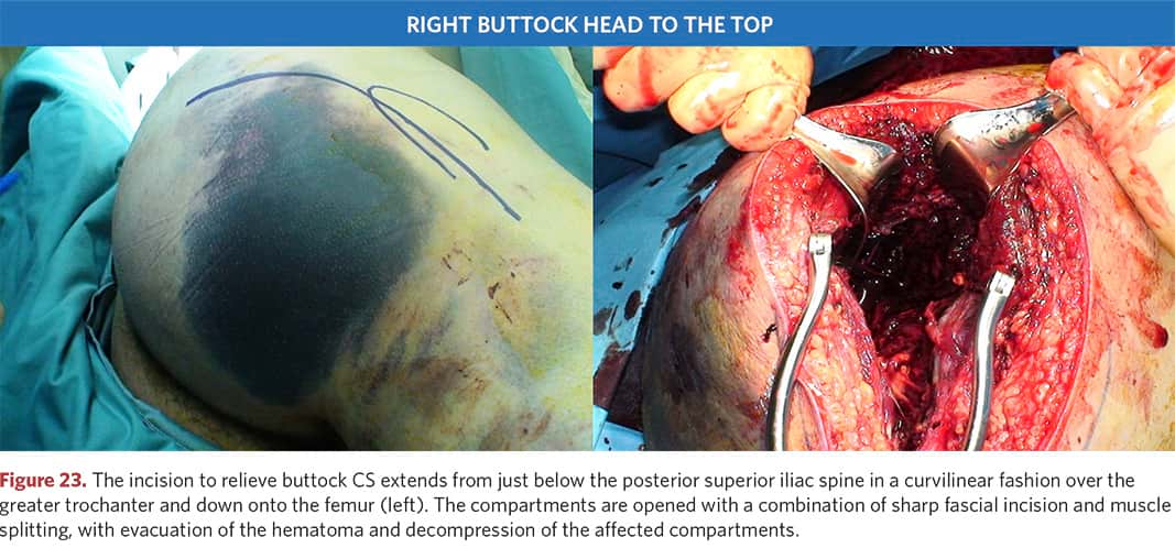 Incision to eliminate buttock stiffness