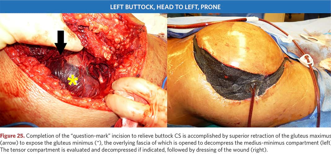 Abduction of the gluteus maximus after incision