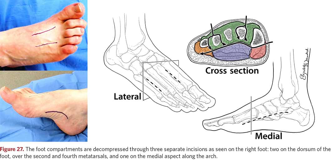 Decompression of foot compartments