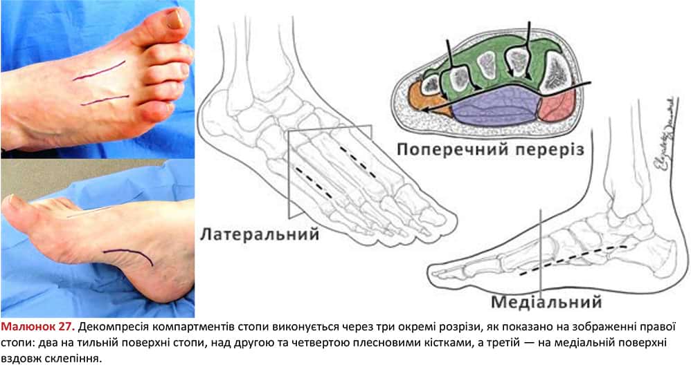 Декомпресія компартментів стопи