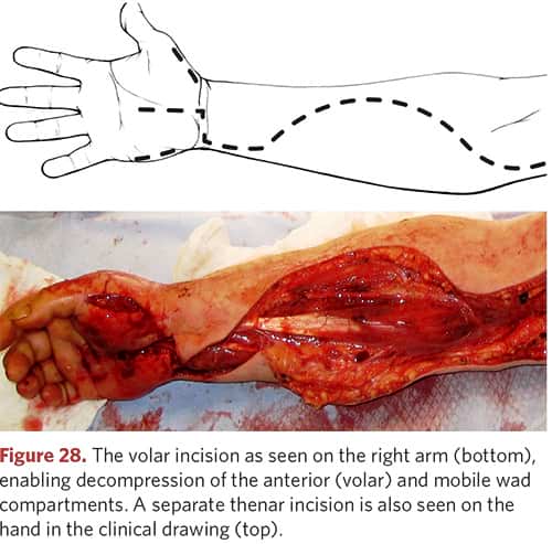 Volar incision on the right hand