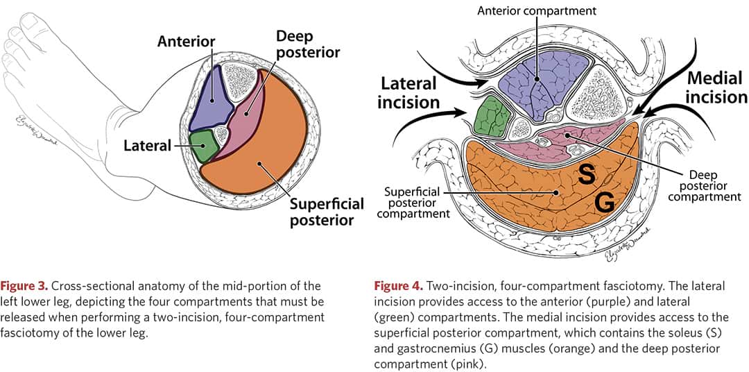 Anatomy and fasciotomy of the middle part of the left tibia