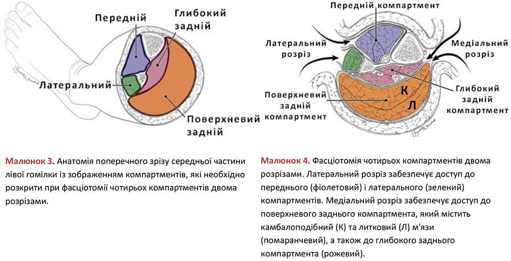 Анатомія та фасціотомія середньої частини лівої гомілки