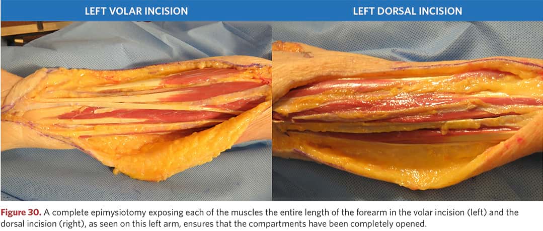 Complete epimysiotomy along the entire length of the forearm