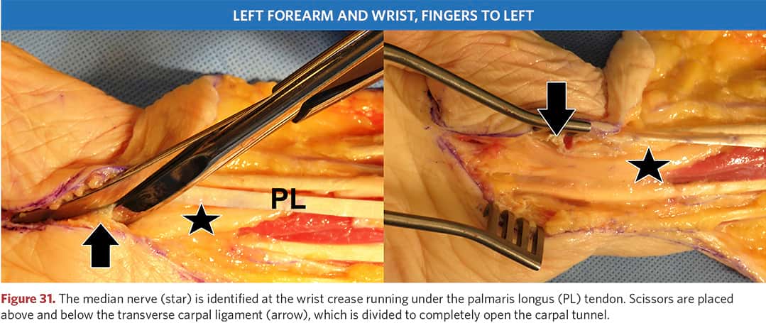 Median nerve under the tendon of the long palmar muscle