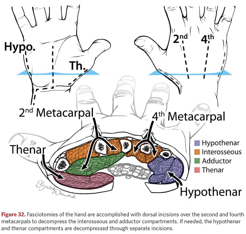 Fasciotomy of the hand - anatomy