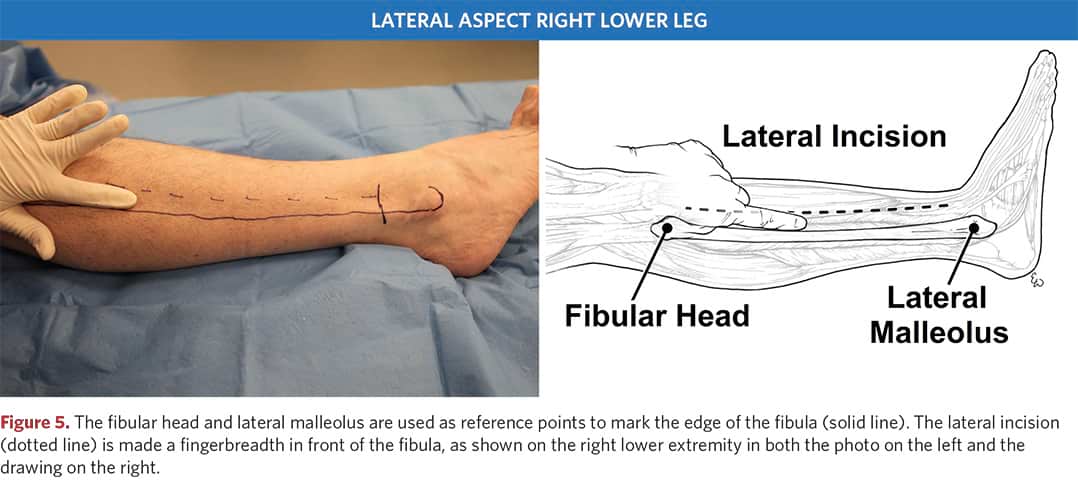 Lateral incision of the right tibia