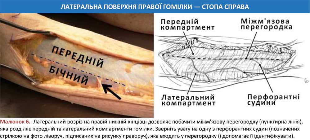 Міжм'язова перегородка на правій гомілці