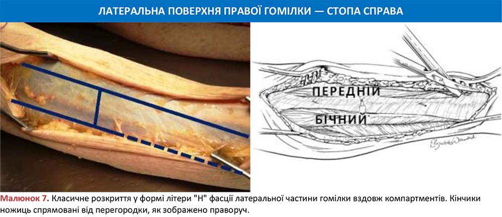 Розкриття у формі літери «Н» фасції латеральної частини гомілки