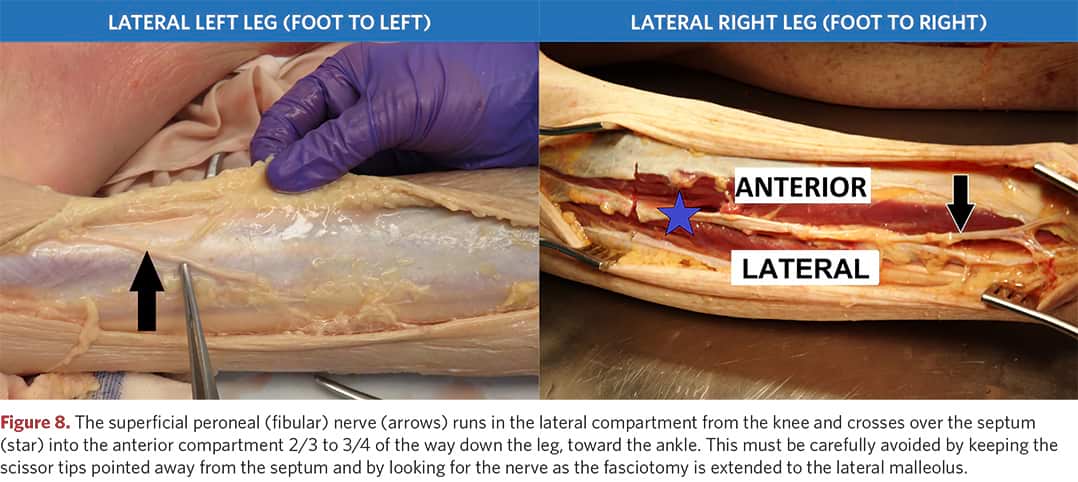 Superficial peroneal nerve