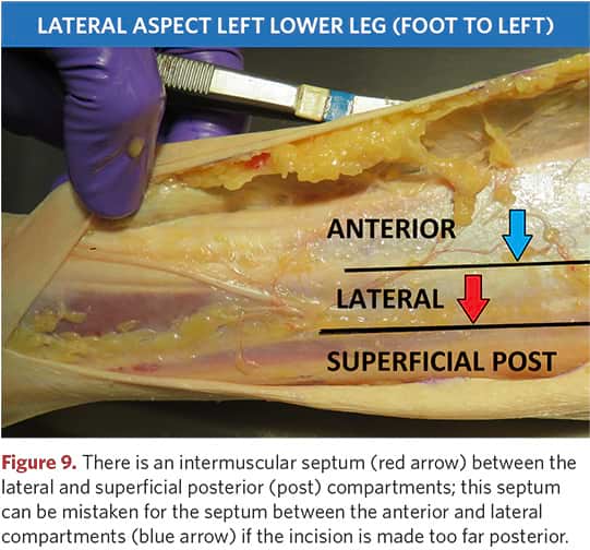 Intermuscular septum of the lateral surface of the left tibia