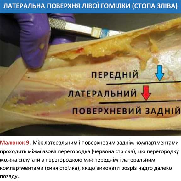 Міжм'язова перегородка латеральної поверхні лівої гомілки