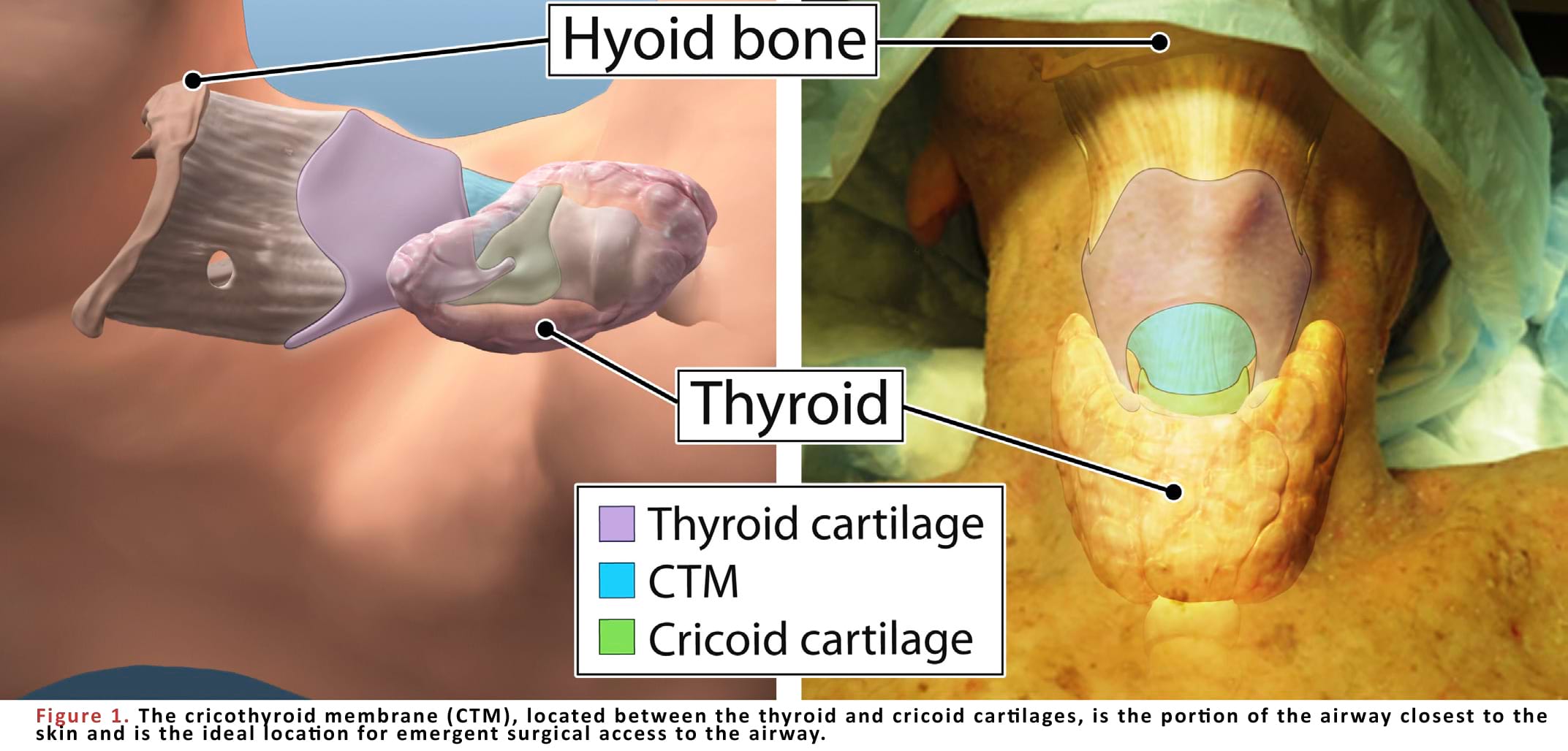 The cricothyroid membrane (CTM)