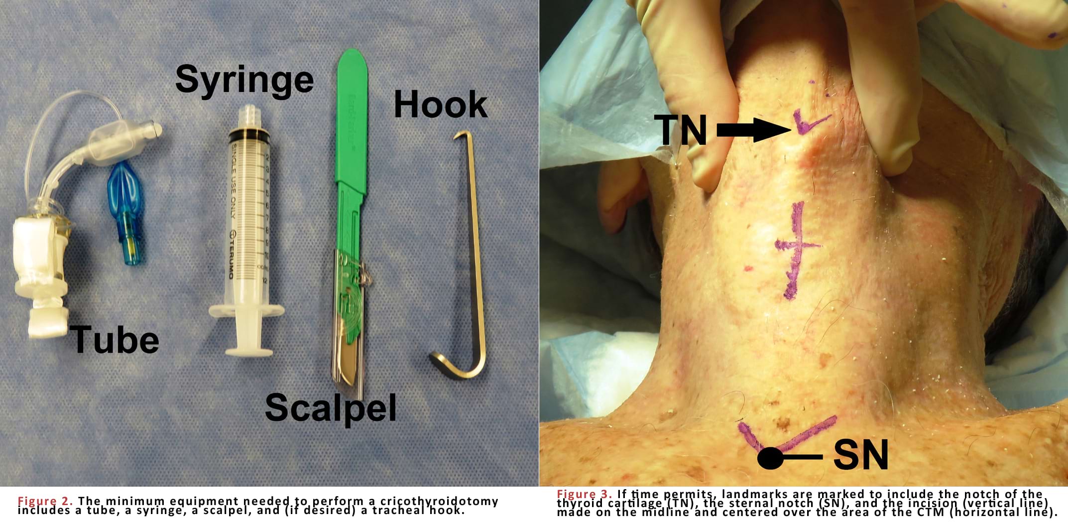 The minimum equipment needed to perform a cricothyroidotomy