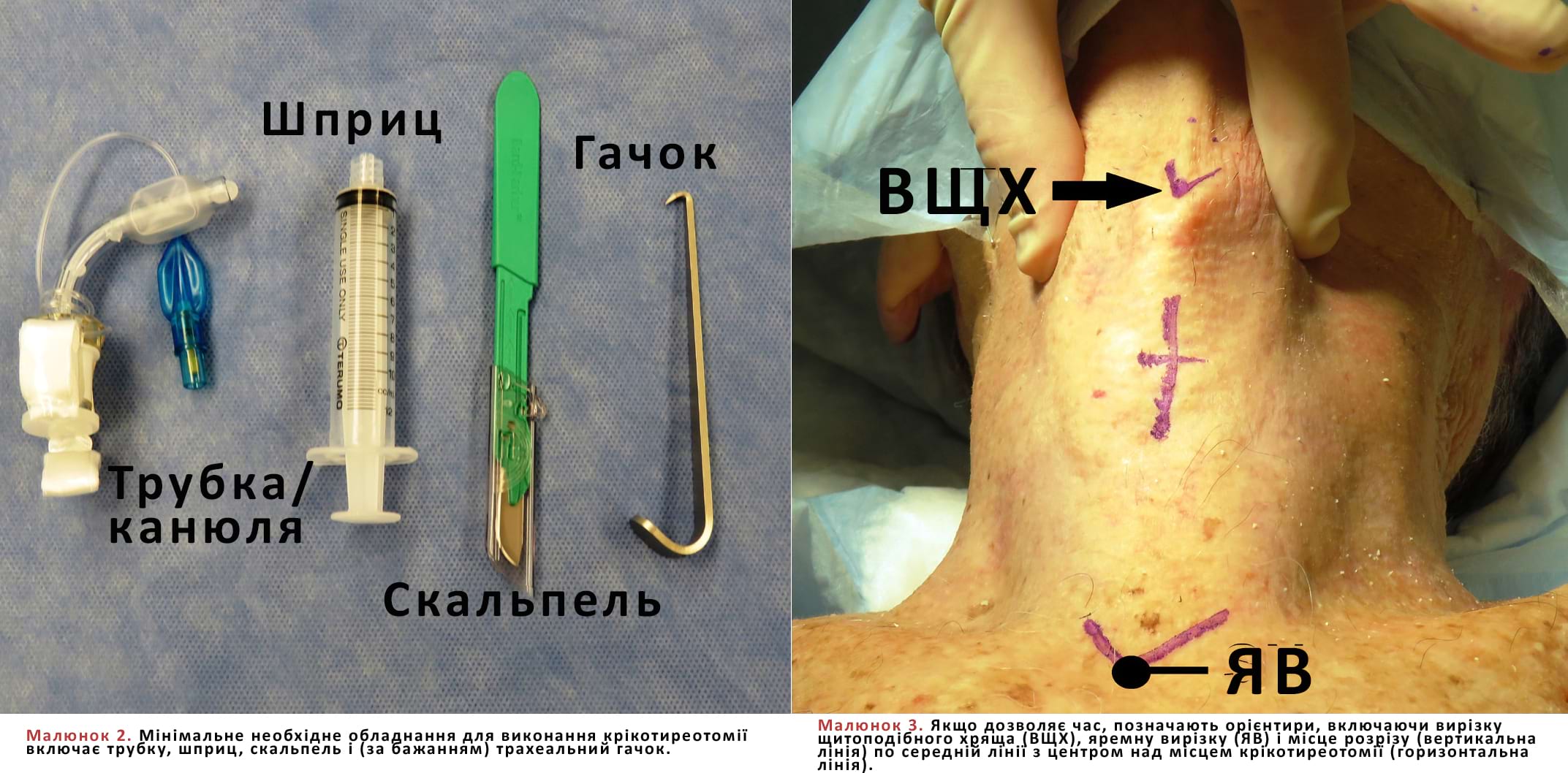 Мінімальне необхідне обладнання для виконання крікотиреотомії