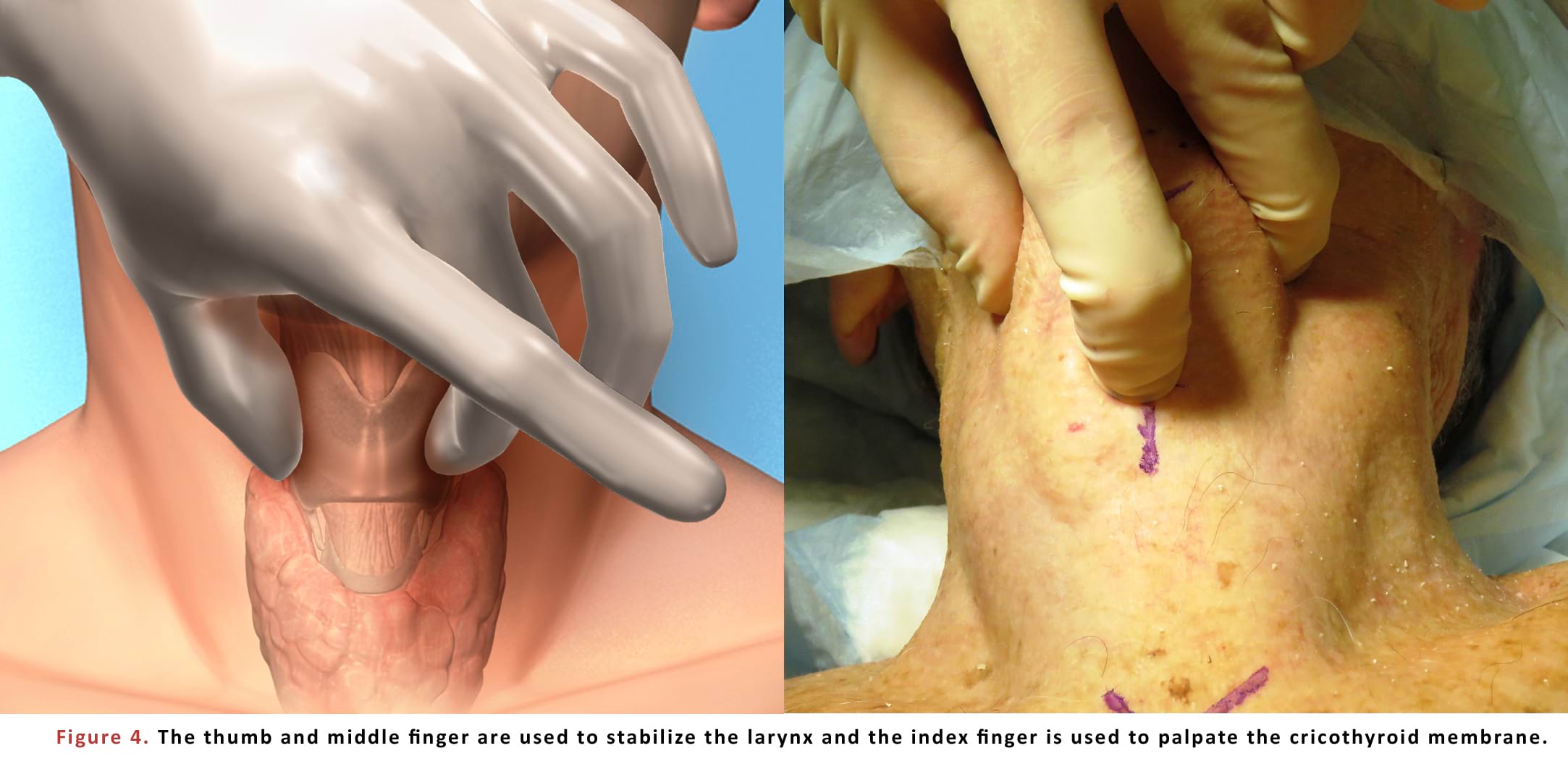 The thumb and middle finger are used to stabilize the larynx and the index finger is used to palpate the cricothyroid membrane.