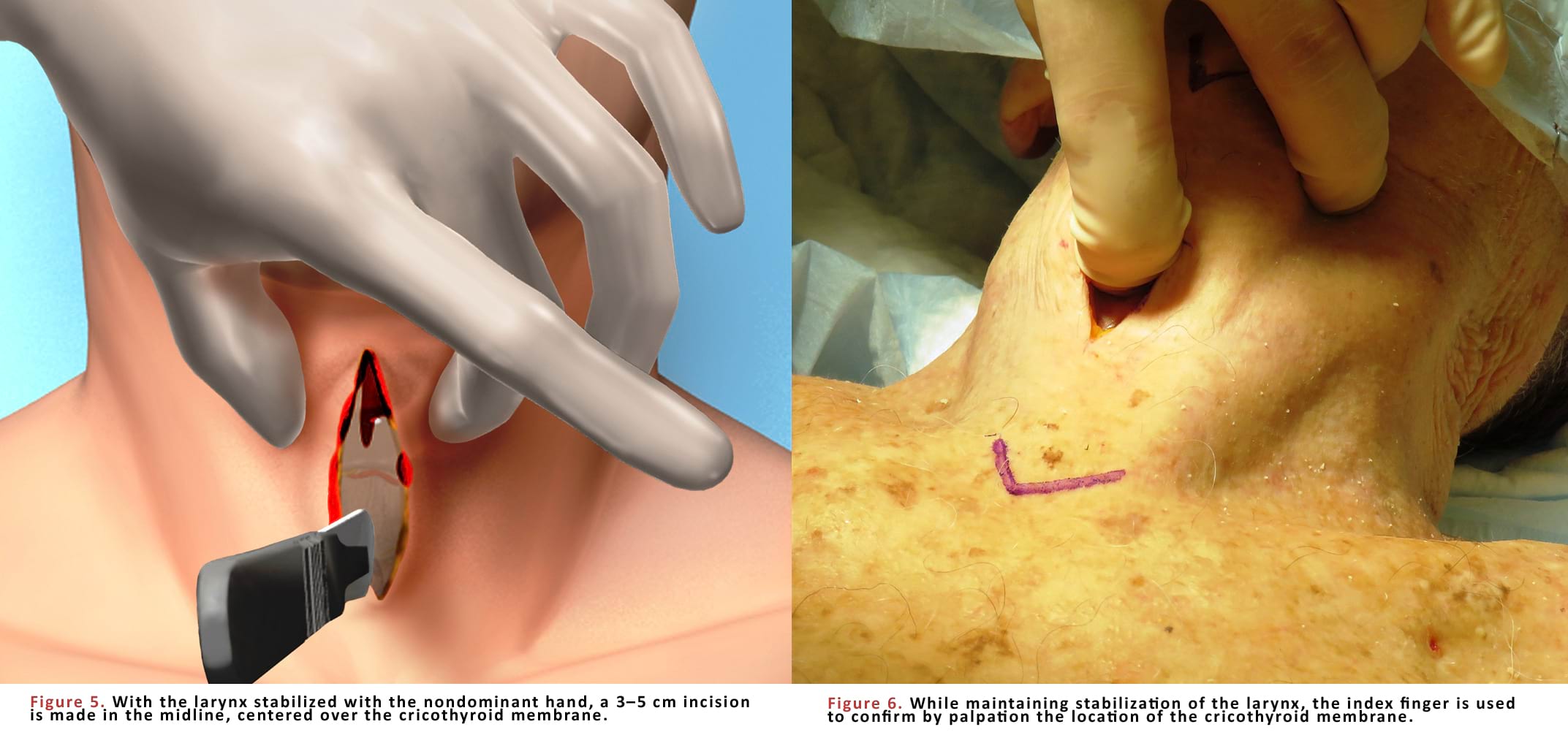 With the larynx stabilized with the nondominant hand, a 3–5 cm incision is made in the midline, centered over the cricothyroid membrane.