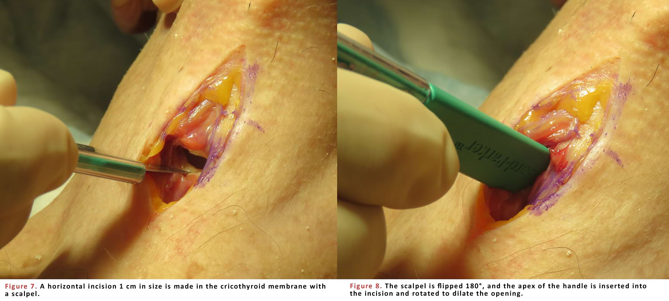 A horizontal incision 1 cm in size is made in the cricothyroid membrane with a scalpel.