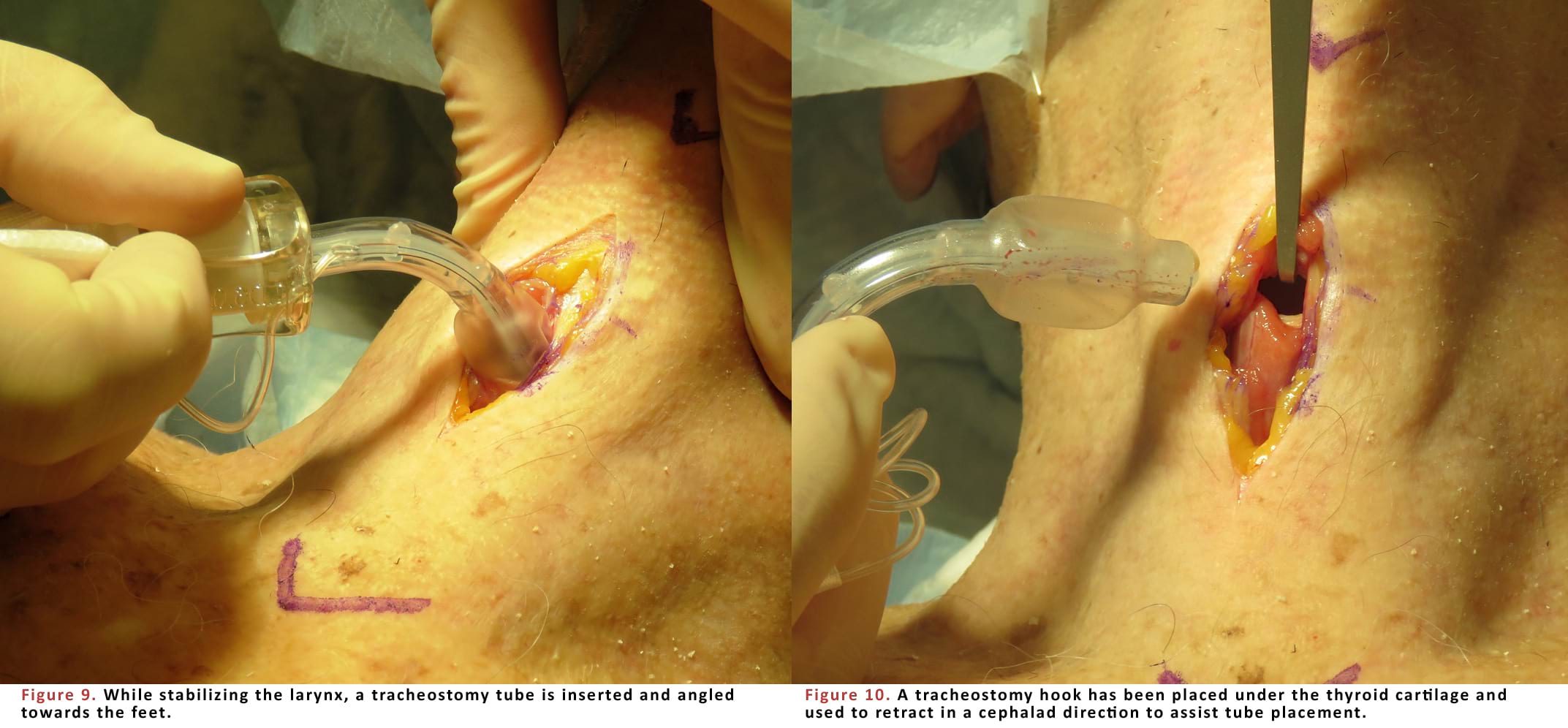 While stabilizing the larynx, a tracheostomy tube is inserted and angled towards the feet.